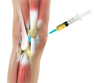 Img-Platelet Rich Plasma Therapy